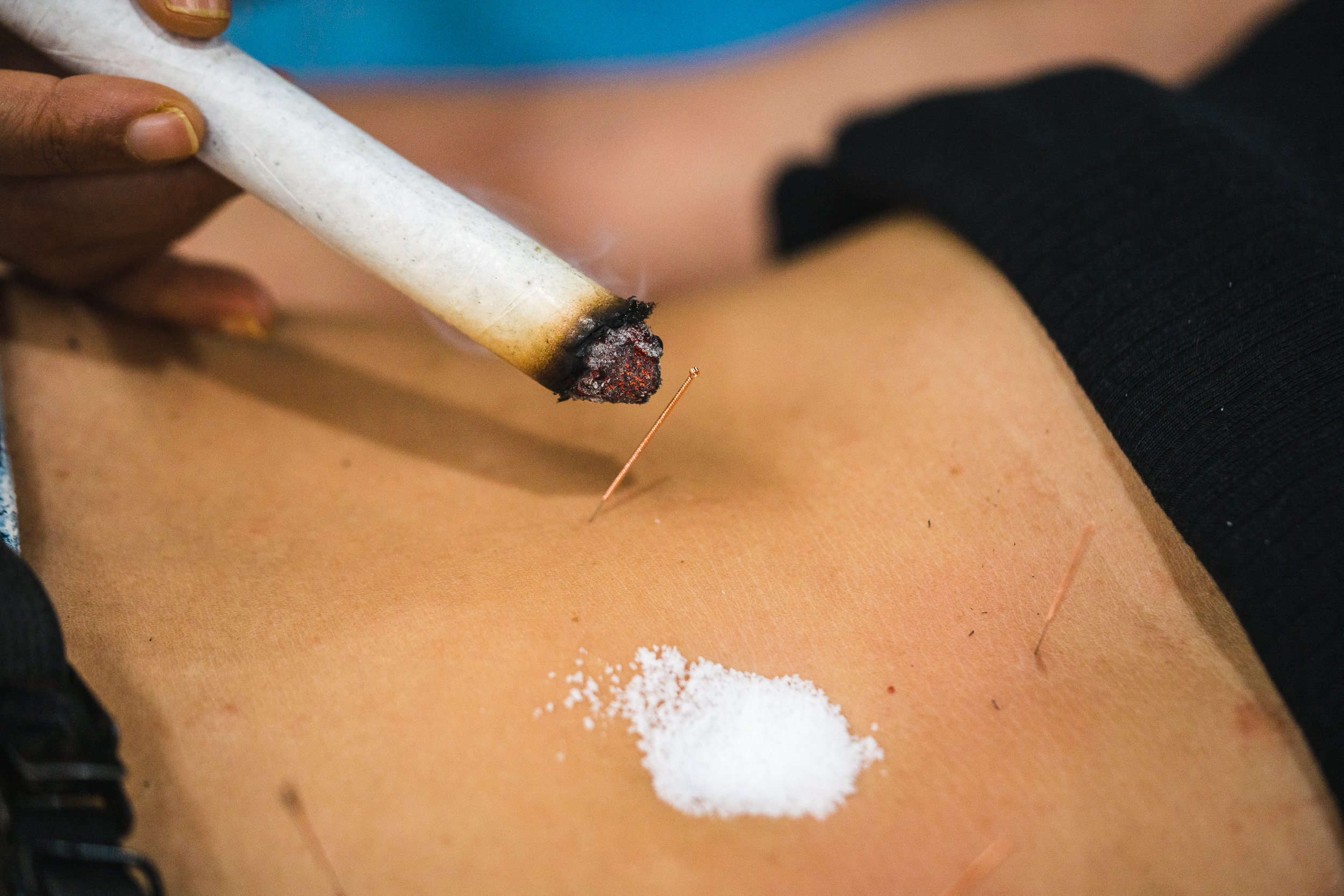 Irina-Thalhammer-Acupuncture-sm